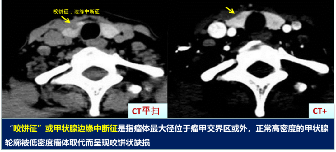 甲状腺结节良恶性的影像鉴别