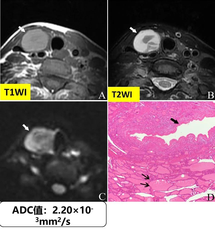 甲状腺结节良恶性的影像鉴别