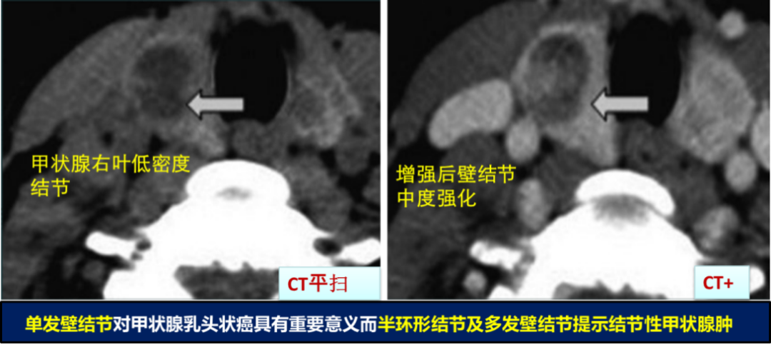 甲状腺结节良恶性的影像鉴别