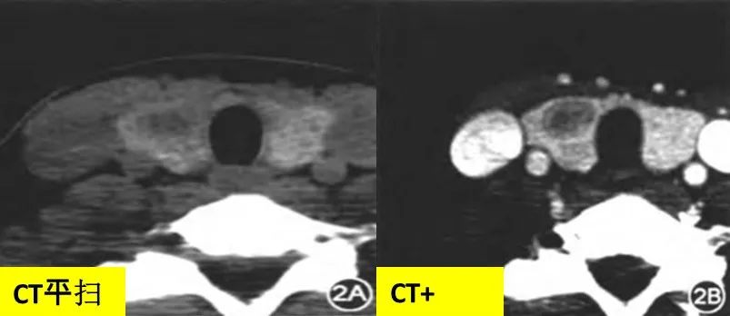 甲状腺结节良恶性的影像鉴别