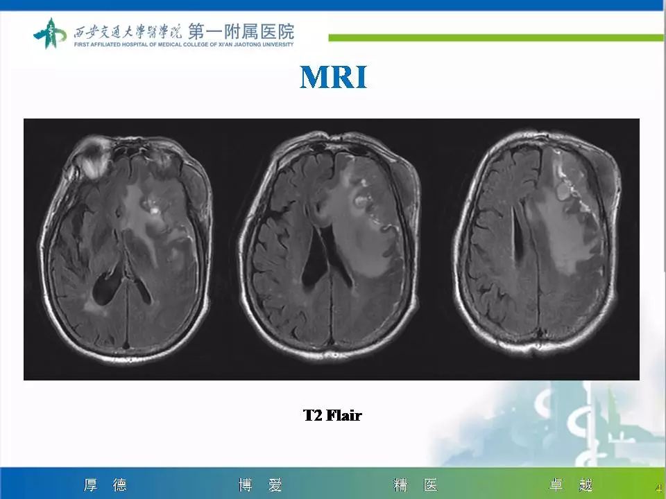 【病例】颅骨浆细胞瘤1例CT及MR影像