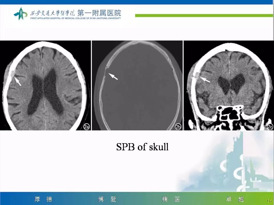 【病例】颅骨浆细胞瘤1例CT及MR影像