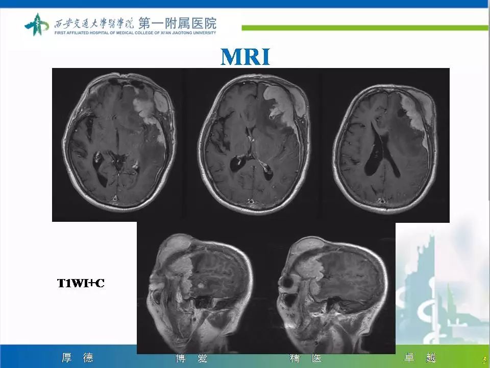【病例】颅骨浆细胞瘤1例CT及MR影像