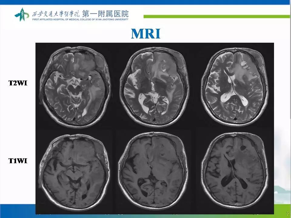 【病例】颅骨浆细胞瘤1例CT及MR影像