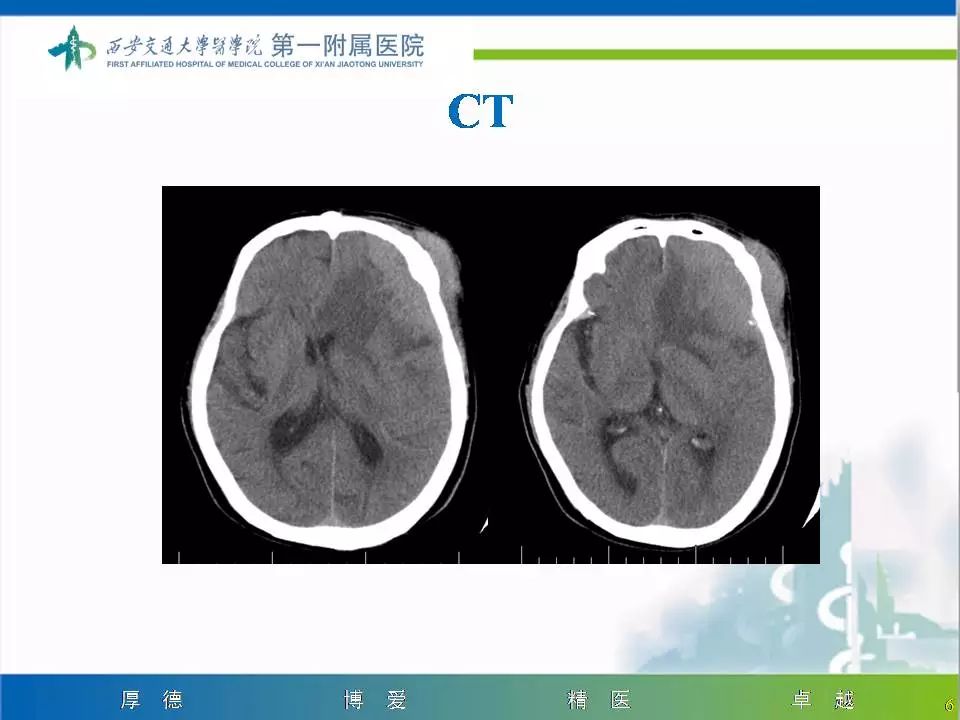 【病例】颅骨浆细胞瘤1例CT及MR影像