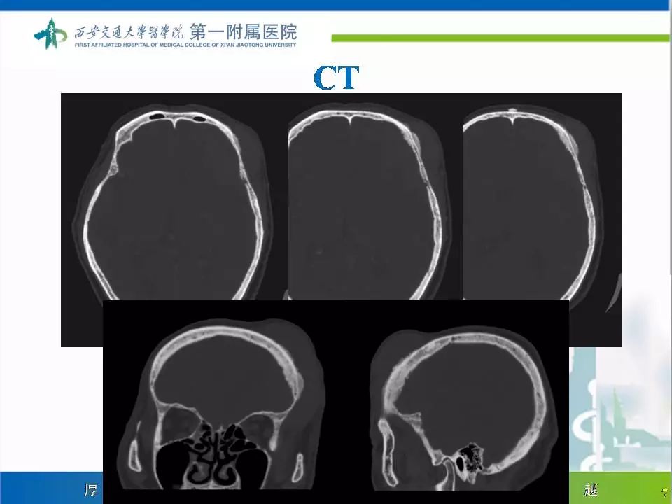 【病例】颅骨浆细胞瘤1例CT及MR影像