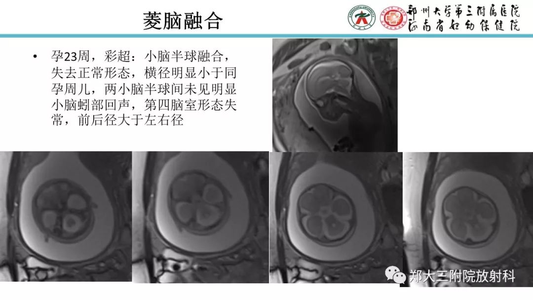 【PPT】胎儿小脑发育及常见疾病的MRI评估