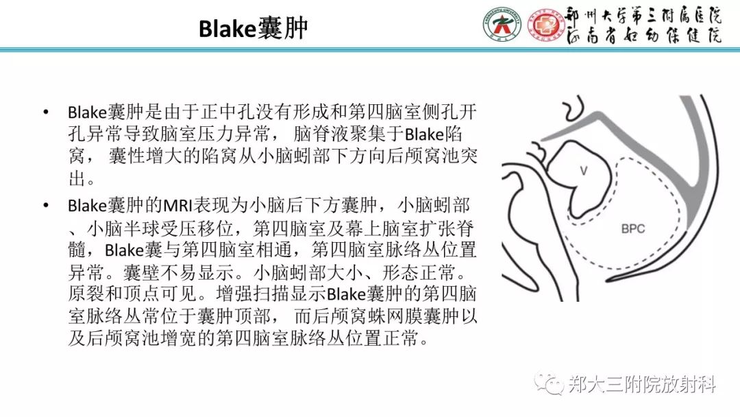 【PPT】胎儿小脑发育及常见疾病的MRI评估