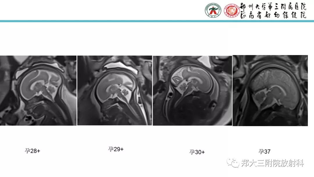 【PPT】胎儿小脑发育及常见疾病的MRI评估