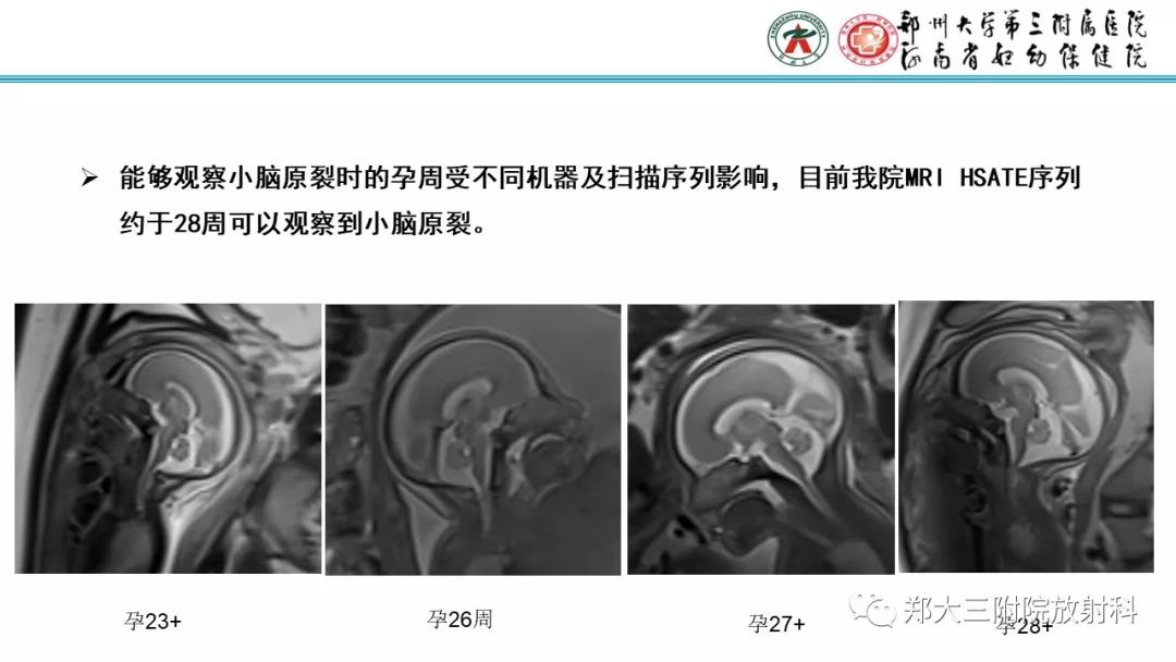 【PPT】胎儿小脑发育及常见疾病的MRI评估