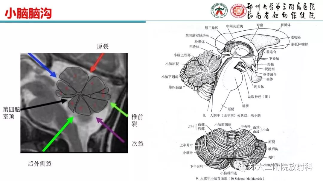 【PPT】胎儿小脑发育及常见疾病的MRI评估