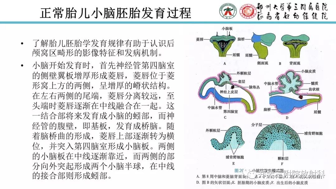 【PPT】胎儿小脑发育及常见疾病的MRI评估