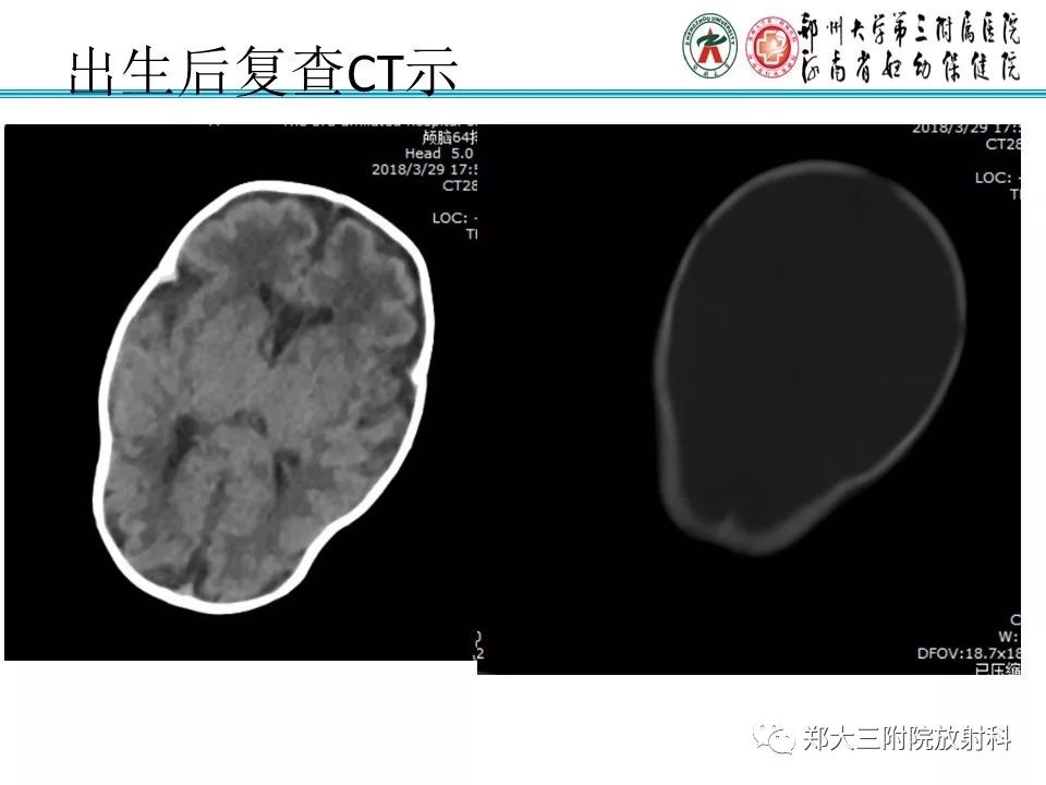 【PPT】颅缝早闭