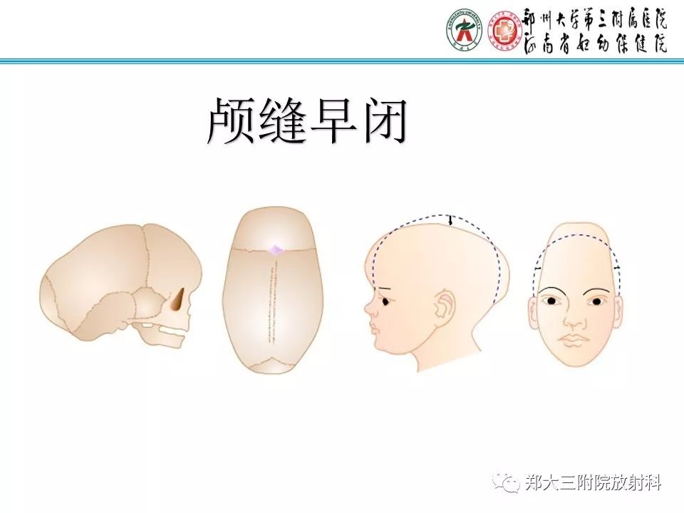 【PPT】颅缝早闭