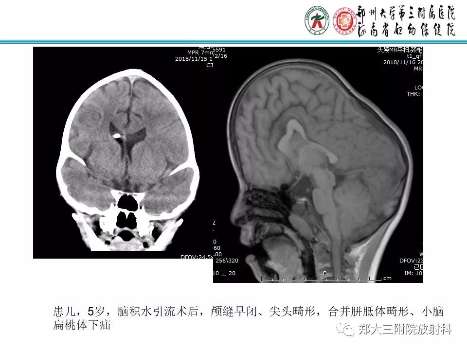 【PPT】颅缝早闭