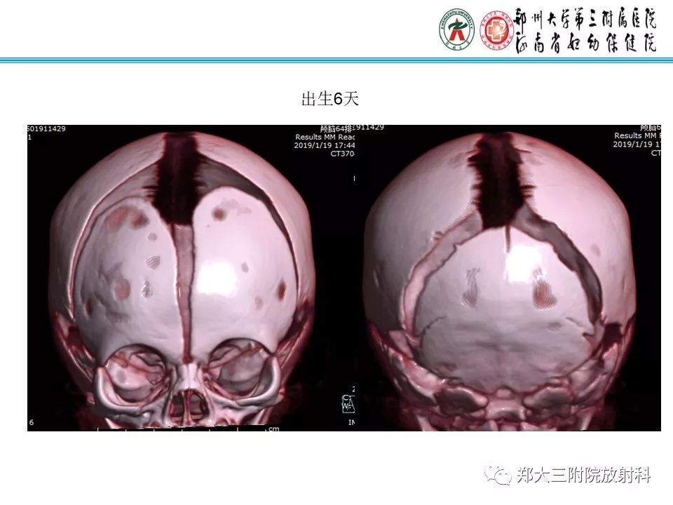【PPT】颅缝早闭