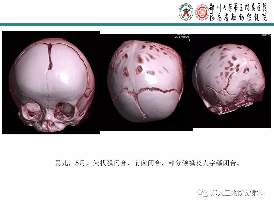 【PPT】颅缝早闭