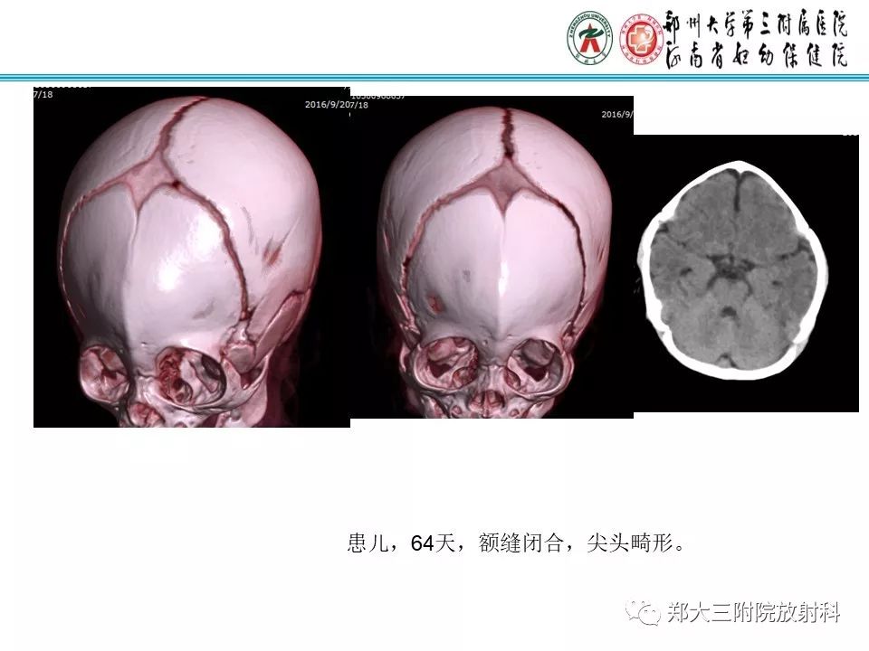 【PPT】颅缝早闭