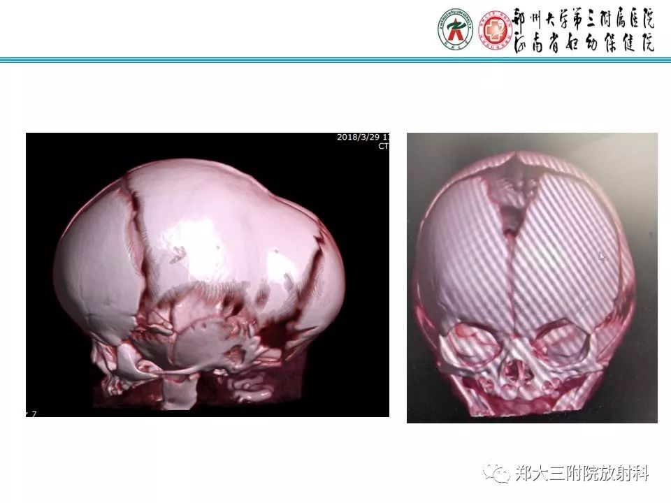 【PPT】颅缝早闭