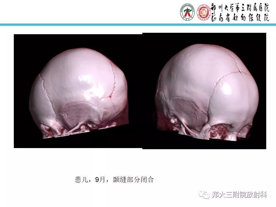 【PPT】颅缝早闭