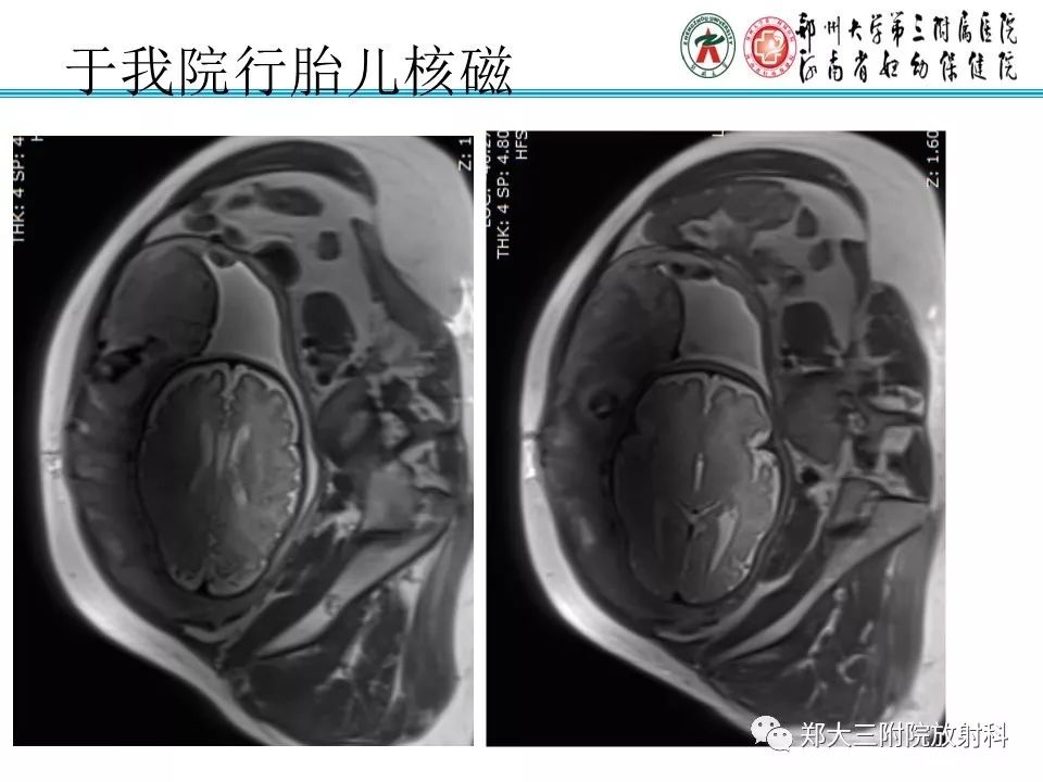【PPT】颅缝早闭
