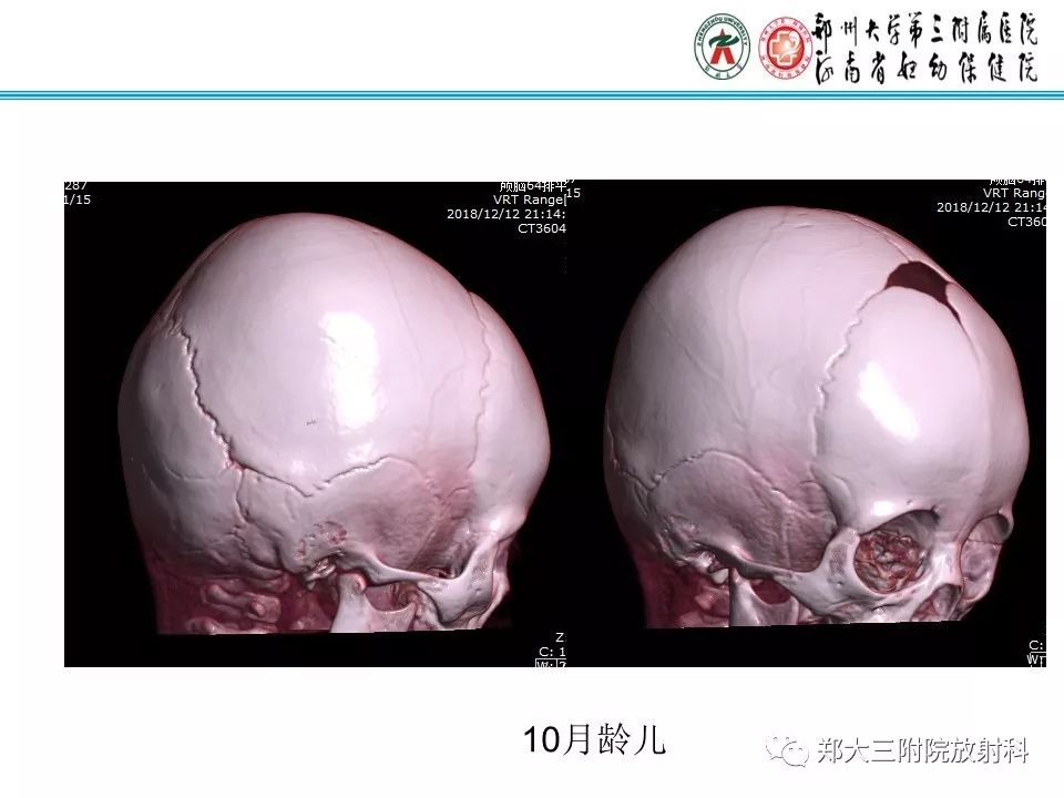【PPT】颅缝早闭