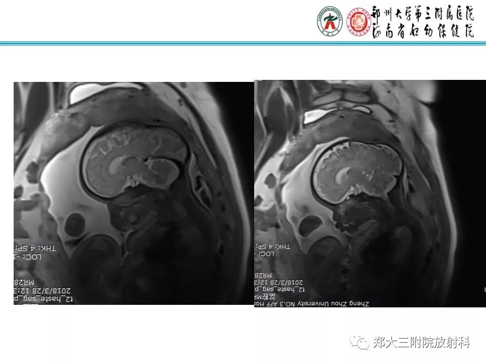 【PPT】颅缝早闭