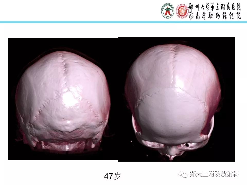 【PPT】颅缝早闭