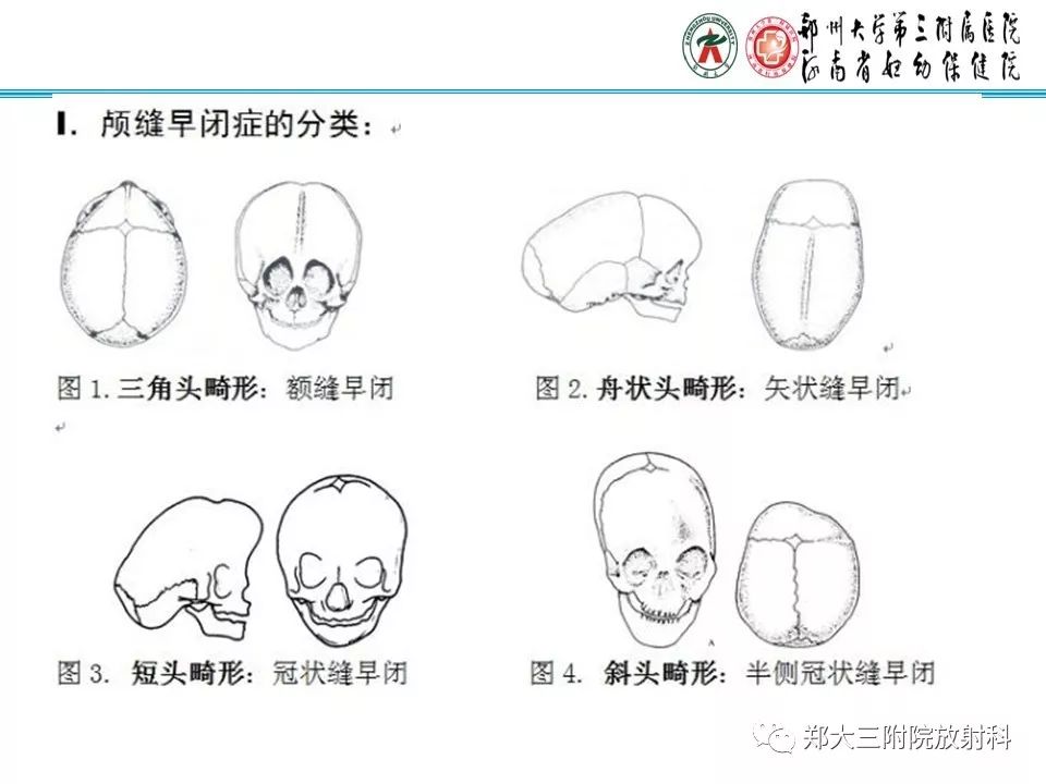 【PPT】颅缝早闭