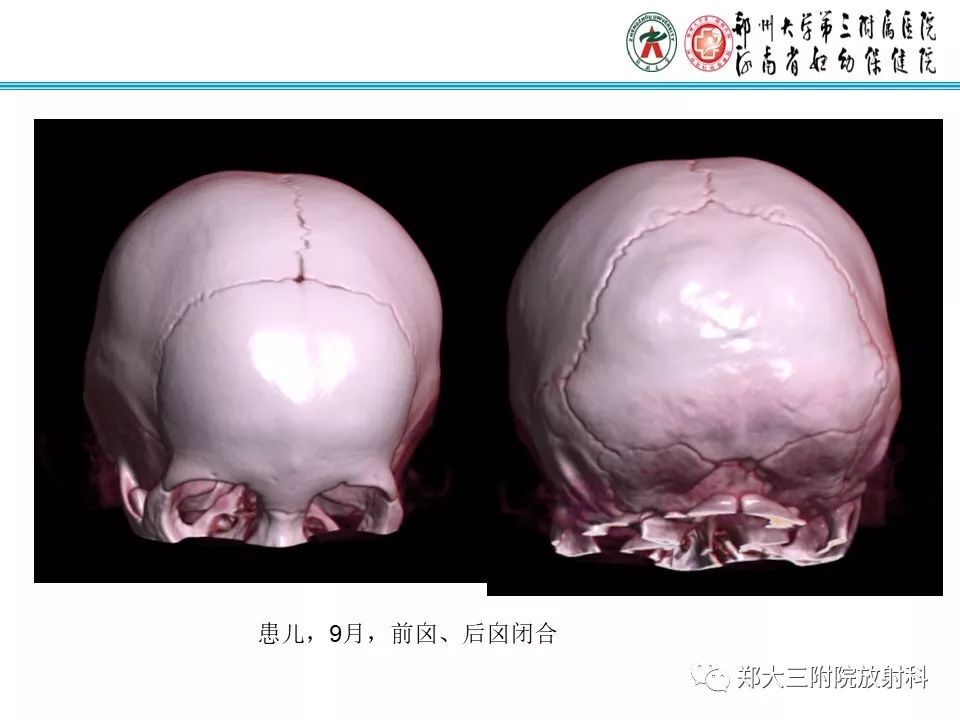 【PPT】颅缝早闭