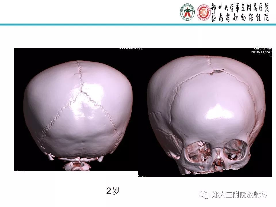 【PPT】颅缝早闭
