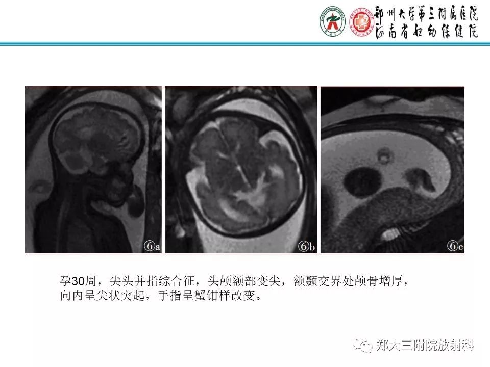 【PPT】颅缝早闭