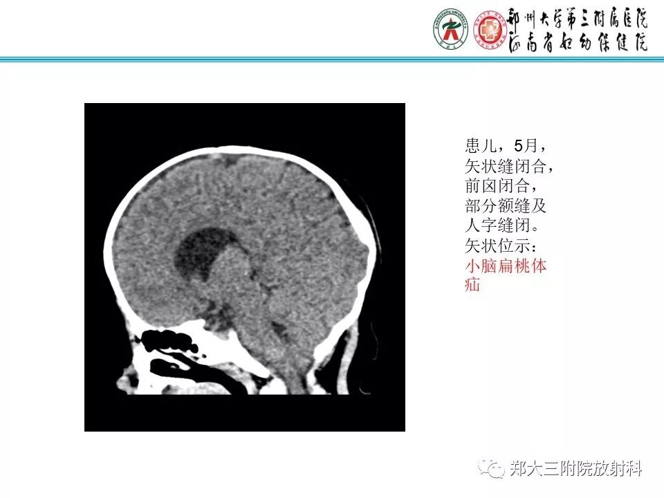 【PPT】颅缝早闭