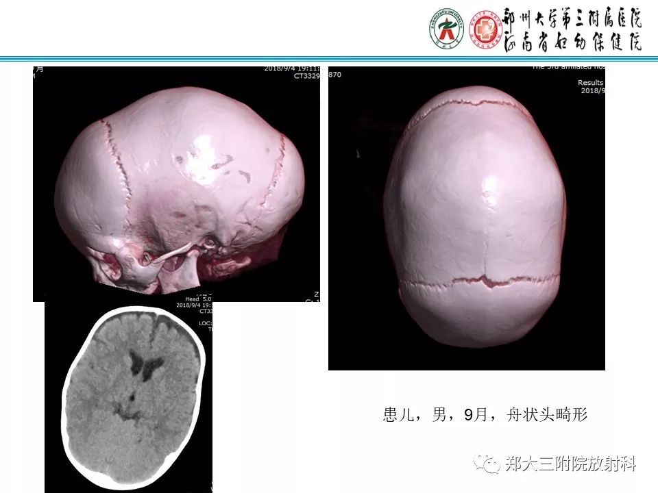 【PPT】颅缝早闭