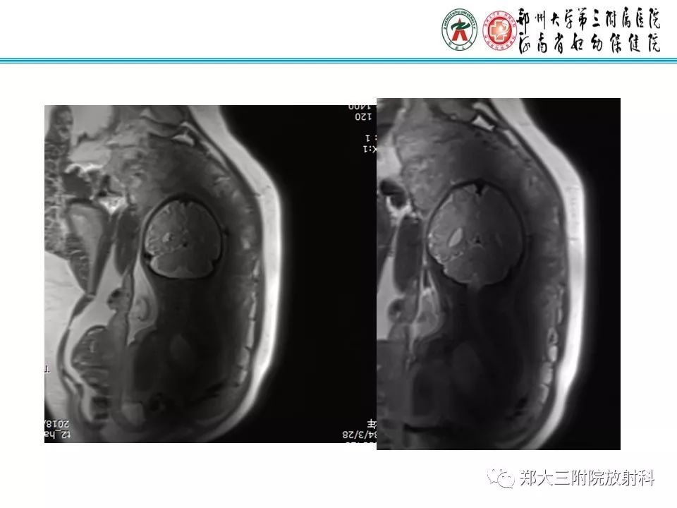 【PPT】颅缝早闭