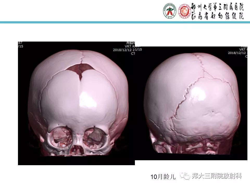 【PPT】颅缝早闭