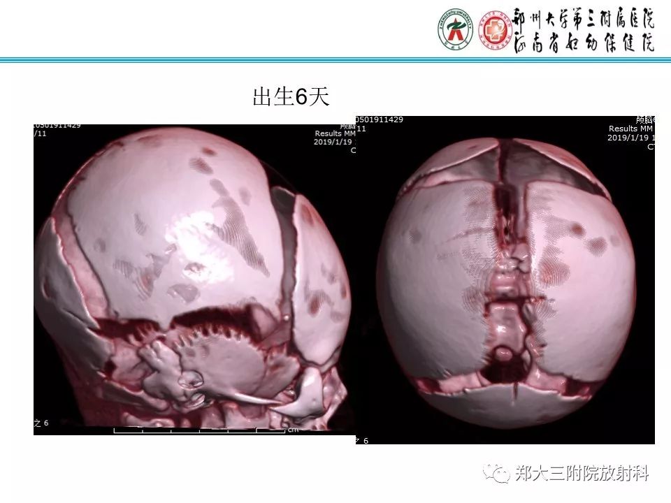 【PPT】颅缝早闭