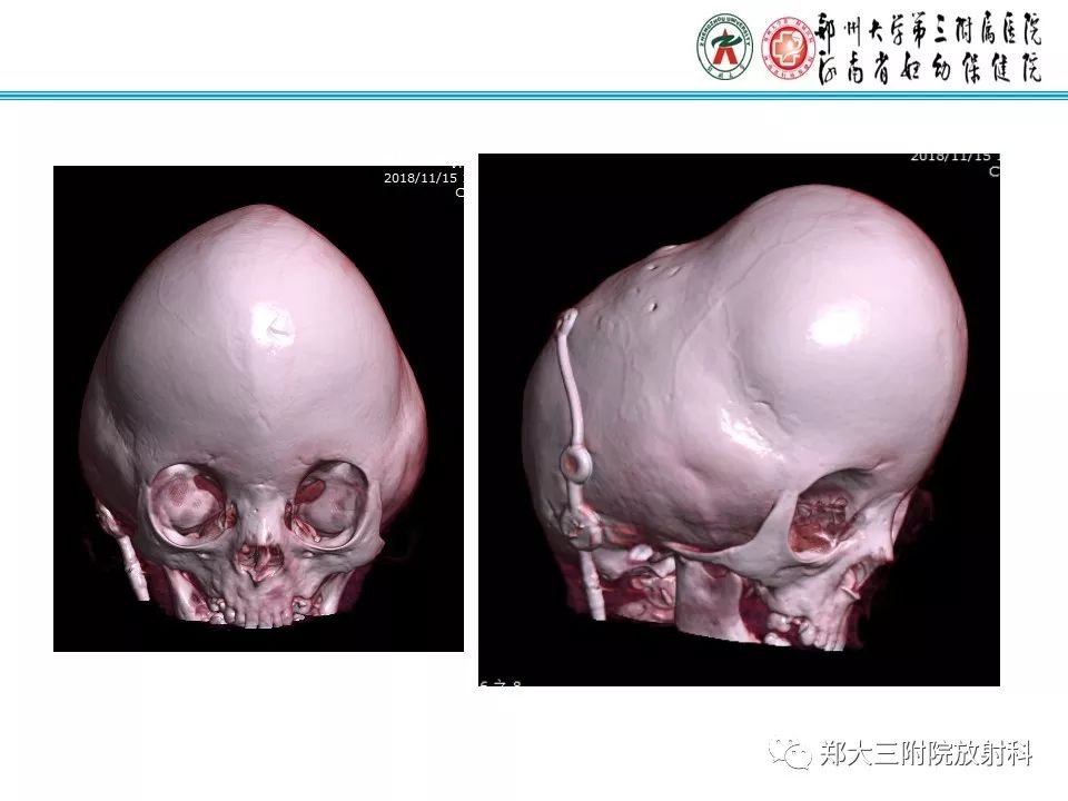 【PPT】颅缝早闭