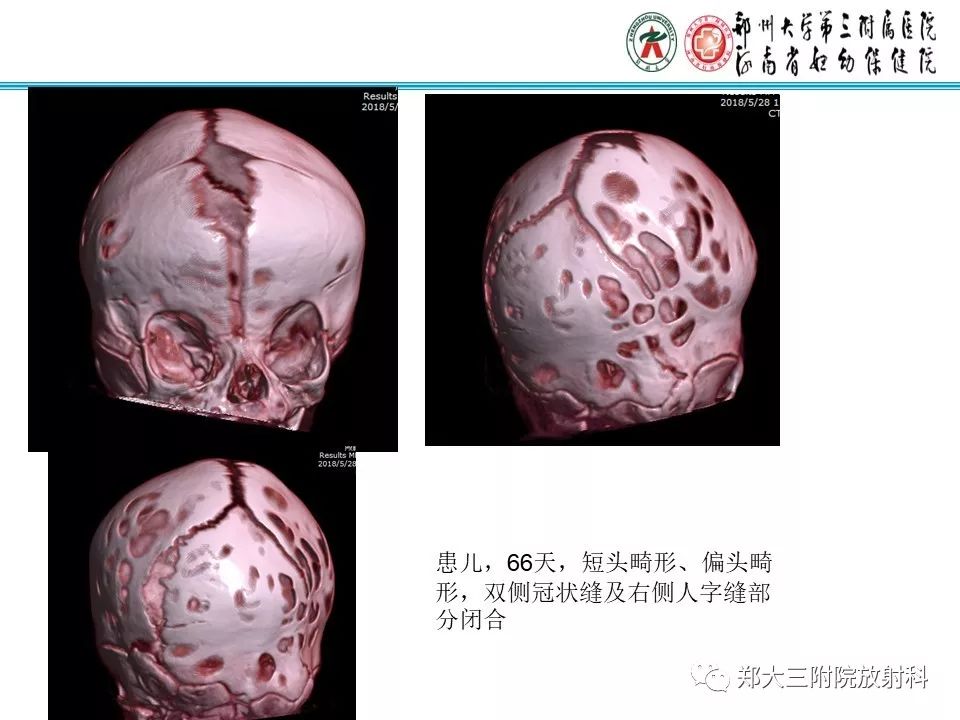 【PPT】颅缝早闭