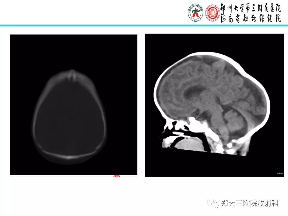【PPT】颅缝早闭