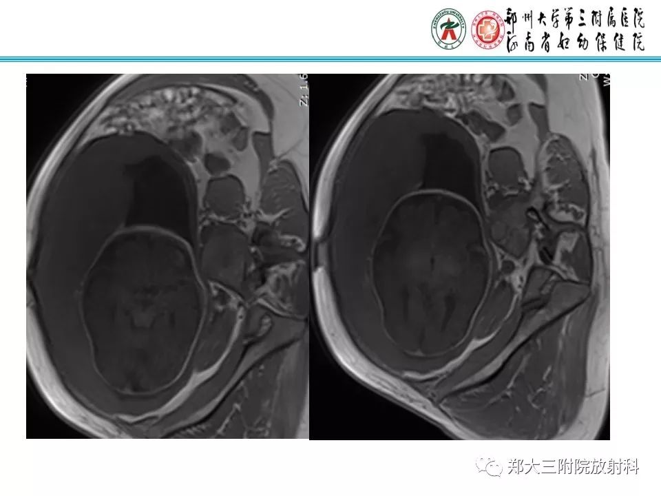 【PPT】颅缝早闭