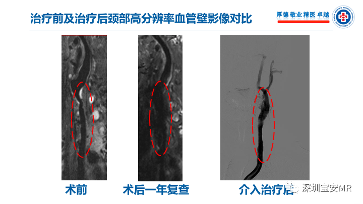 【病例】卒中诊治利剑—MR血管壁技术评估病例展示