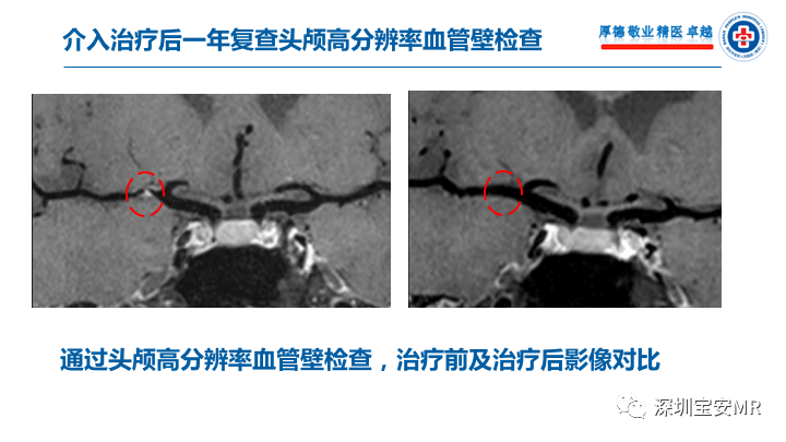 【病例】卒中诊治利剑—MR血管壁技术评估病例展示