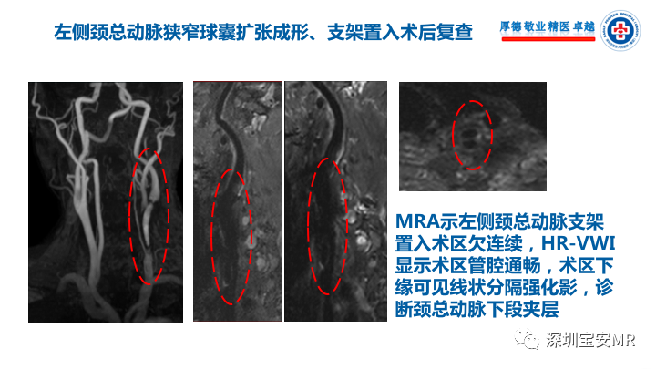 【病例】卒中诊治利剑—MR血管壁技术评估病例展示