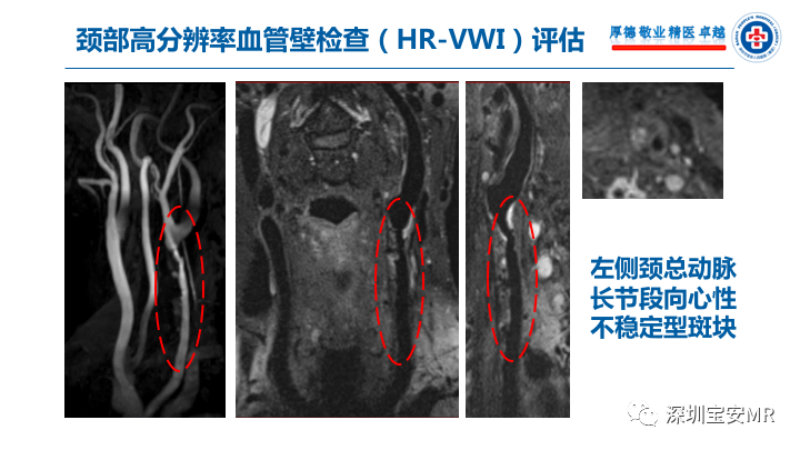 【病例】卒中诊治利剑—MR血管壁技术评估病例展示