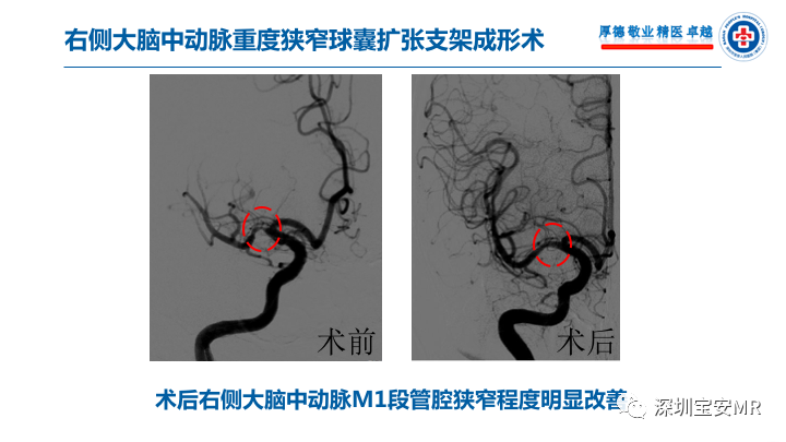 【病例】卒中诊治利剑—MR血管壁技术评估病例展示
