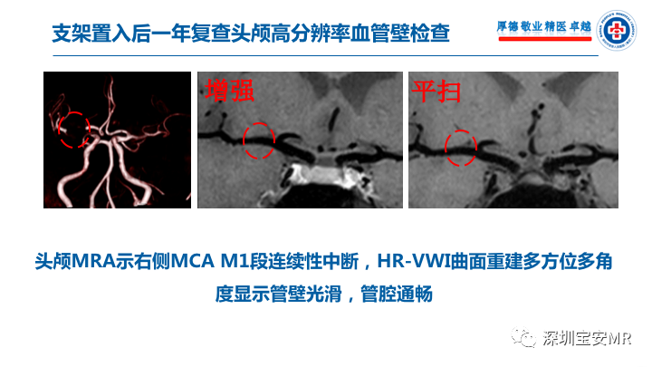 【病例】卒中诊治利剑—MR血管壁技术评估病例展示
