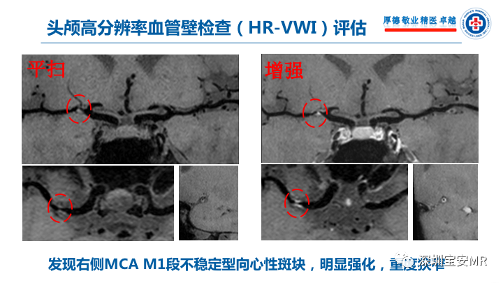 【病例】卒中诊治利剑—MR血管壁技术评估病例展示