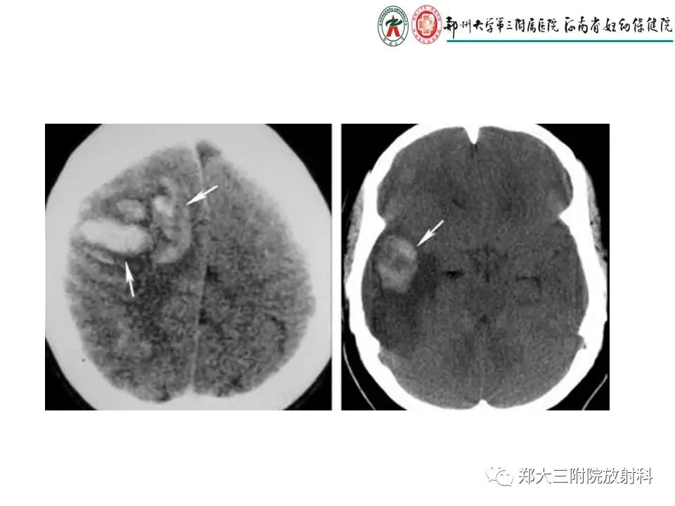 【PPT】静脉窦血栓的影像诊断及误区