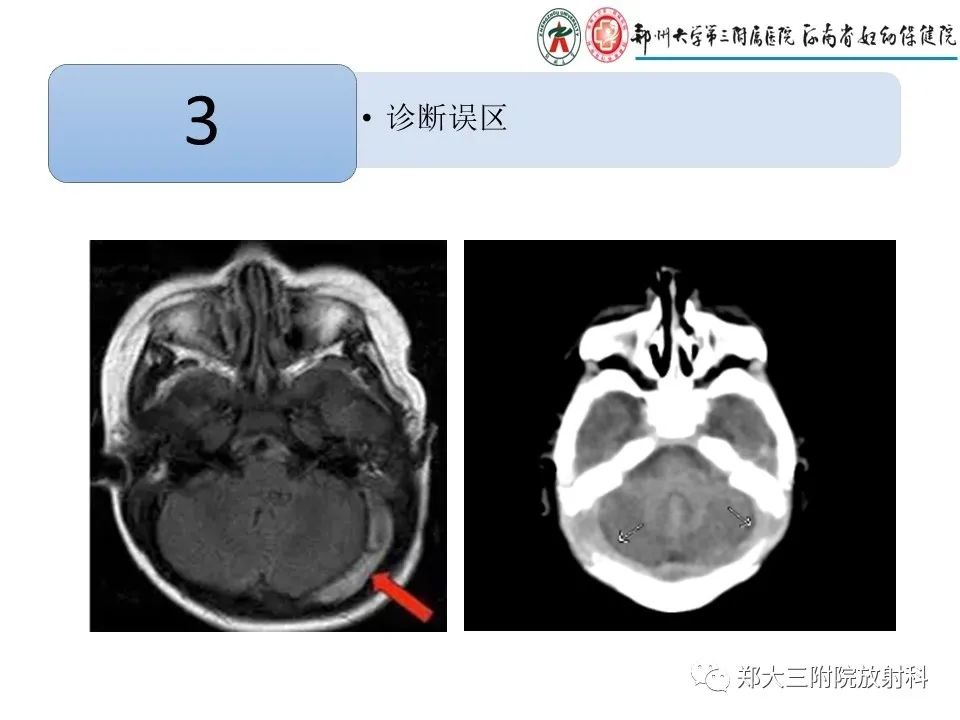 【PPT】静脉窦血栓的影像诊断及误区